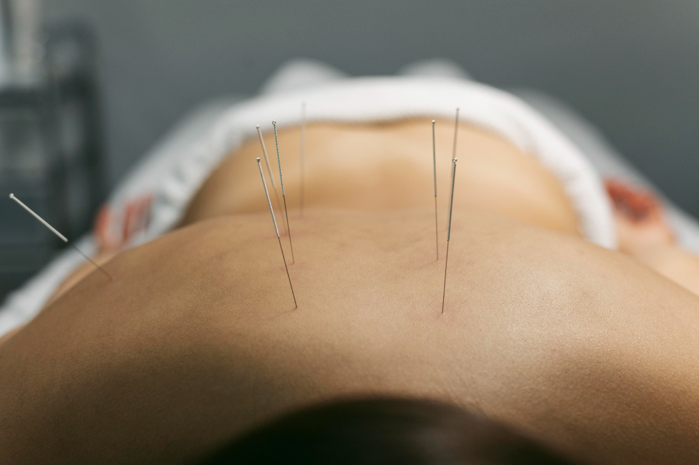 Acupuncture