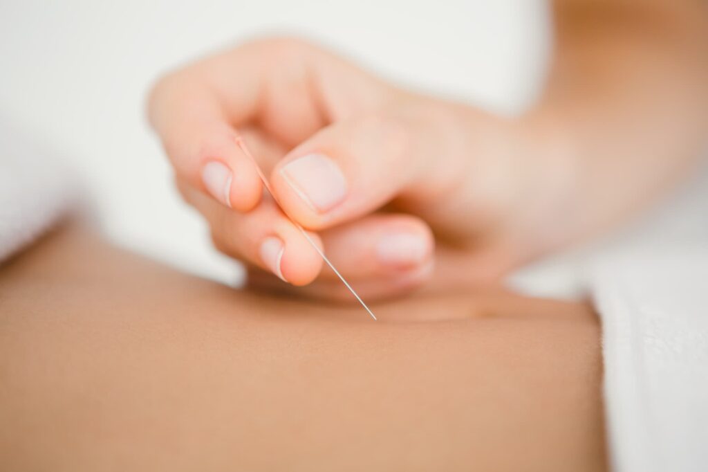 Acupuncture needle