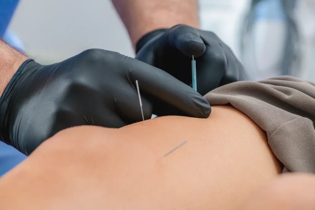 IMS and Dry Needling